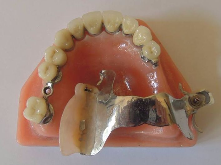 Протез Прецизионного Прикрепления